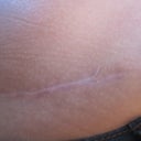 2013 - Love this!  9 months after scar revision - look at how light the scar is!!  A few months ago it was red!  See ladies - look at that!  I can't imagine how great it will look in a year or more!