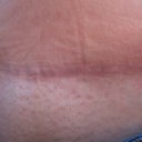 2013 - 9 months post scar revision - 1/1/13 This is the lower middle part of my scar - where I caused tension & stretching - just how I heal I guess!  It was very red a month ago & now it is fading so nicely to a skin color.  I am so pleased!