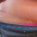 2013 - 9 mo post scar & dog ear revision - You can see the lump of dog ear & also the scar comes 2 inches higher over my swimsuit line.  It does not look so great, but the good part is the scar is fading beautifully & will hardly be noticable one day.  Stinky part is I have to heal another scar there from another dog ear removal.