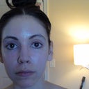 6 month post peel