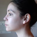 6 month post-op profile.