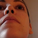 6 month post-op nostril