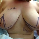 Getting marked up before surgery