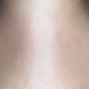 2.5 weeks after surgery with overhead lighting