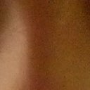 3 weeks after surgery with side lighting - see crater on right eye corner (left in photo)