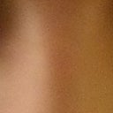 3 weeks after surgery with side lighting, while smiling - see horrible shadow on right eye (left in photo)