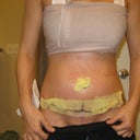 Pot op Day 6- still very swollen