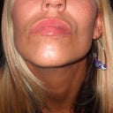 This was right after I got my injections...