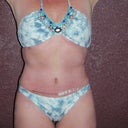 5 Weeks and 4 days post op.  Still swollen on the right hip where I rejected the stitch.  Taken end of day. You can also see the scars from the laser lipo on my breast.