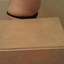 Before pic. 57 days preop.