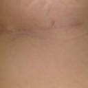 DAY 11: Scar under right breast