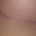 DAY 11: scar under left breast