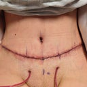 Few hours after surgery.