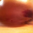 Scar seems like it will heal nicely! :)