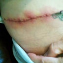 What infected incision looks like.  Hurts worse then the TT!