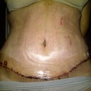The wounds on my left front are from the tape when it was pulled, I'm putting neosporin on it everyday, what do u girls think? I  like the results so far.
