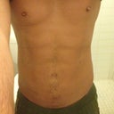 Two weeks post op. I've got another appointment with Dr. Lanzer tomorrow to check how I'm healing, and seem to be doing well. There is still swelling, mainly around the flanks/love handle area. I'm happy with my results so far, and looks like you aren't even going to be able to see the incision sites.