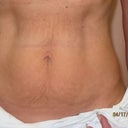 Pre-op