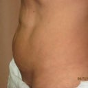 Pre-op