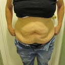 Front view-2.5 months pre-op.Here's the damage.I have managed to loose 80lbs since my daughters birth and keep off 60lbs of it.Now I'm working on the other 20lbs
