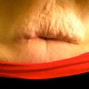 before surgery (after weight loss of 1/2 body weight)