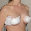 Right Angle - 1 Day Post-Op