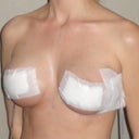 Left Angle - 1 Day Post-Op