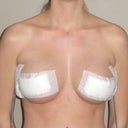 Front - 1 Day Post-Op