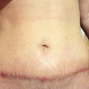 Post op day 20