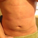 4weeks post op