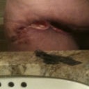left hip almost 6 weeks post op
