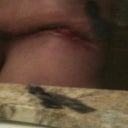right hip almost 6 weeks post