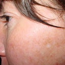 before treatment, left side of face