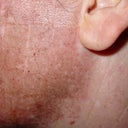 left side of face, hours after surgery