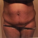 Pre-op...I hated my body