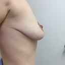 2 weeks side view, worst looking angle