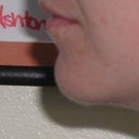 Chin Augmentation