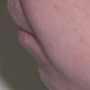 Chin Augmentation