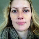Post-op, day six - stitches and splint removed!