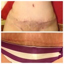 Upper photo is 2 weeks post op. lower photos is 2 months post op. incision is very low. It goes right above my hairline. My panties are pulled down a bit to show you, otherwise you wouldn't see it.