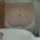 Pre-op - the chunk that has GONE!