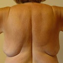 Arm Lift