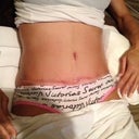 today 14 days post op .. some areas healed ...