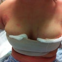 2 hrs after surgery