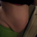 3 months pre-op, before weight loss. Weight 174