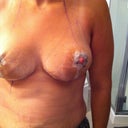 day 2 post op
