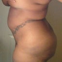 ME b4 pick (1 week pre op)