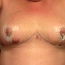3 days post op