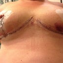 3 days post op