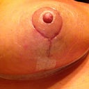 20 days post op